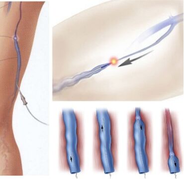 varisli damarları tedavi etme yöntemi - endovenöz lazer pıhtılaşması