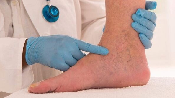 varisli damarları olan bacakları inceleyen doktor